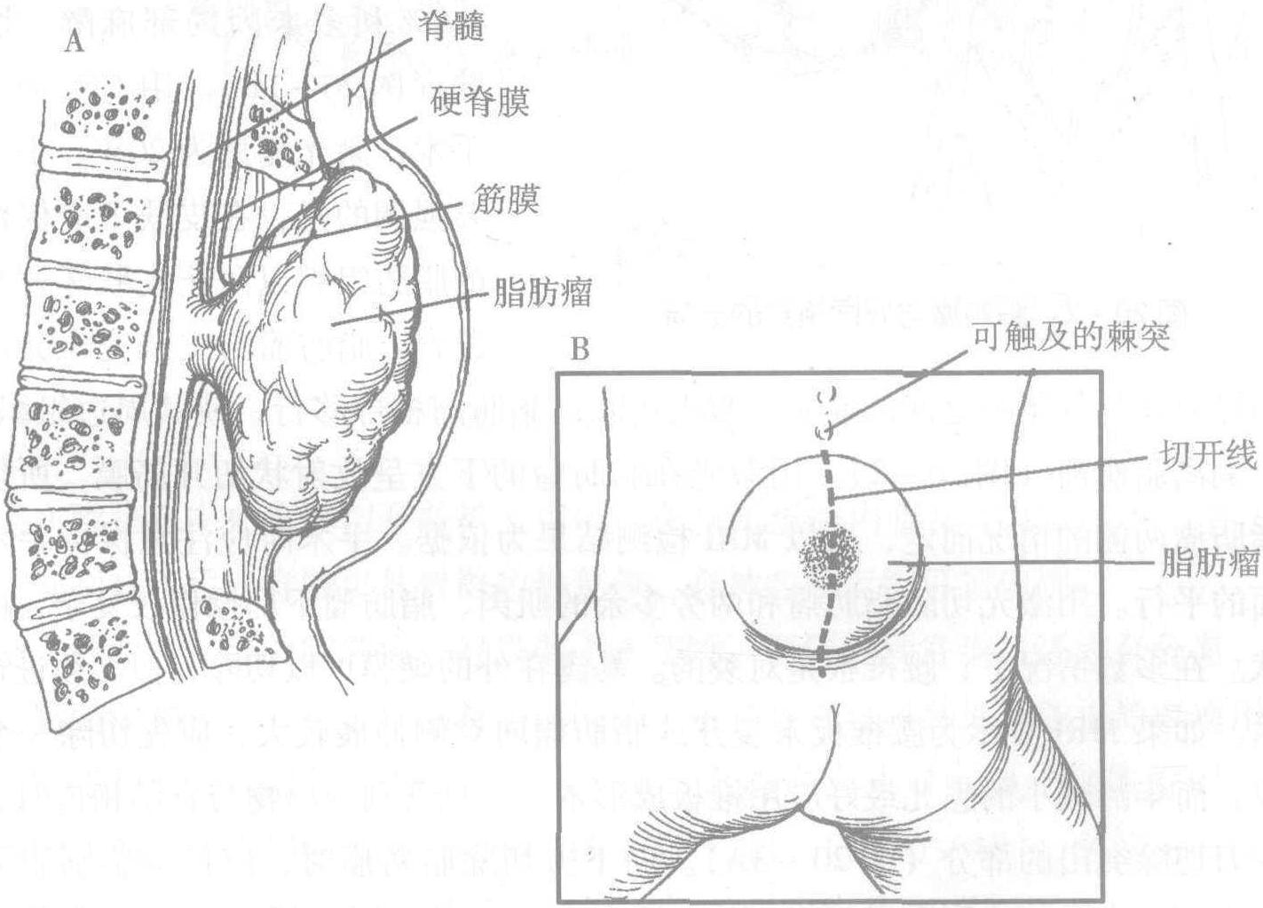 第二十章 脂肪瘤性脊髓脊膜膨出手術(shù)療法